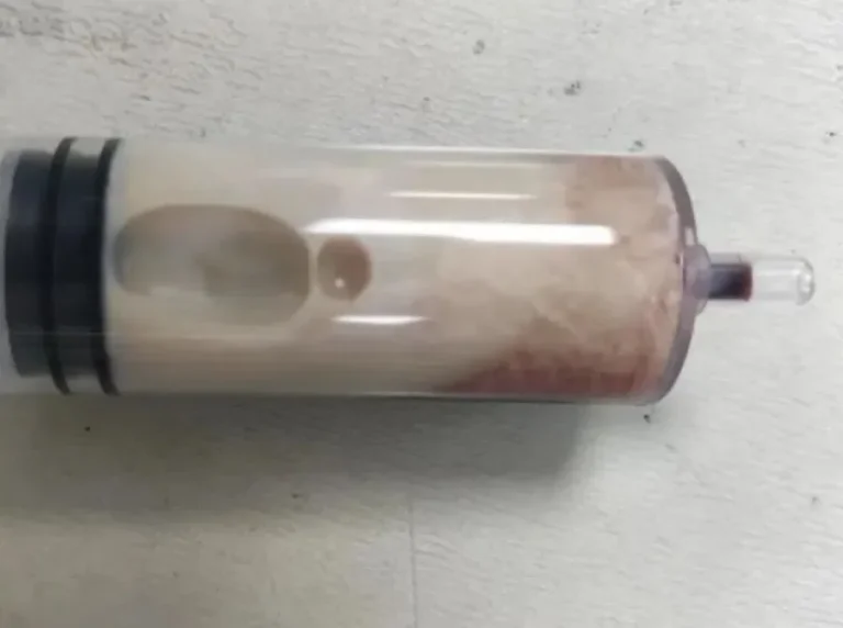 Extraen leche y no sangre a hombre que sólo comió hamburguesas