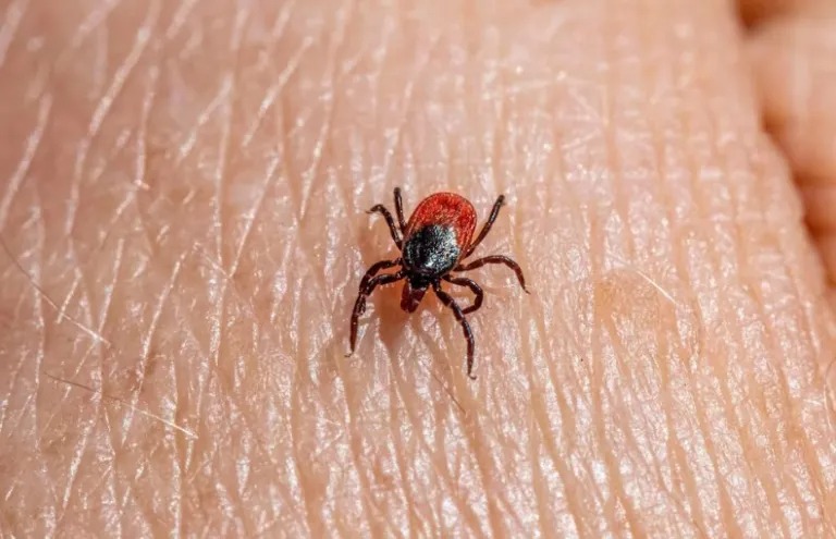 Encuentran larvas de garrapata en una niña.