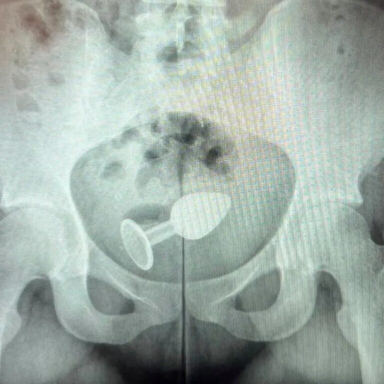 Mujer sufre accidente con juguete sexual