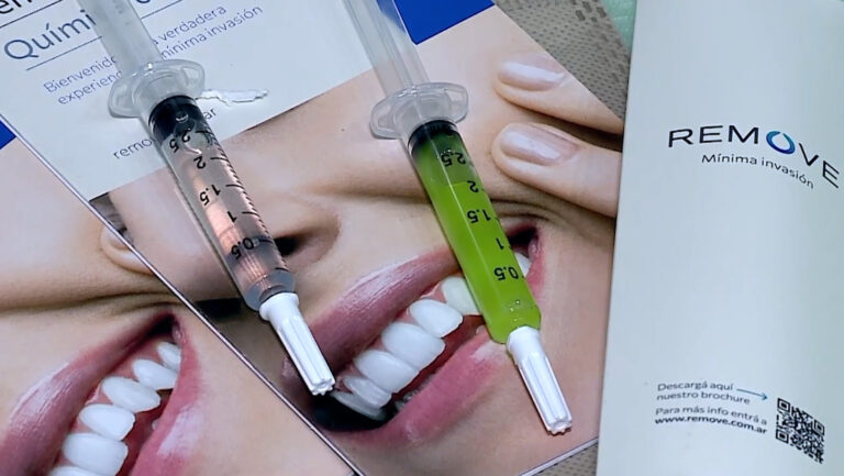 Crean gel capaz de remover caries sin uso del torno