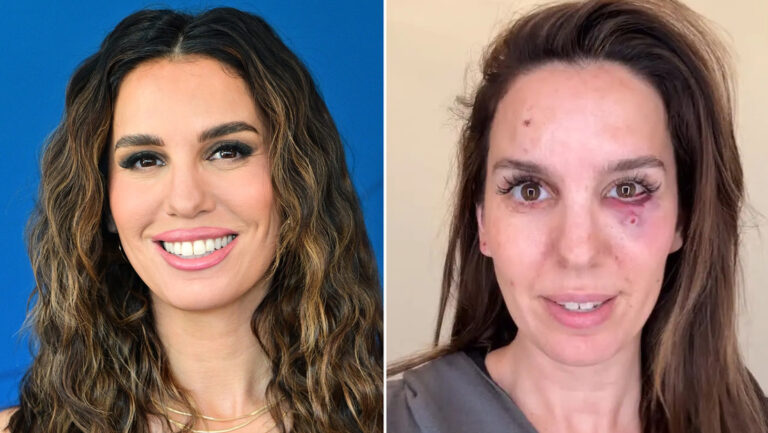 Actriz resultó herida tras recibir cinco balines en su rostro