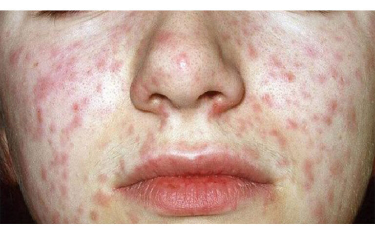 Conoce el Plan de Acción del Ministerio de Salud ante la alerta internacional de Sarampión en Nicaragua