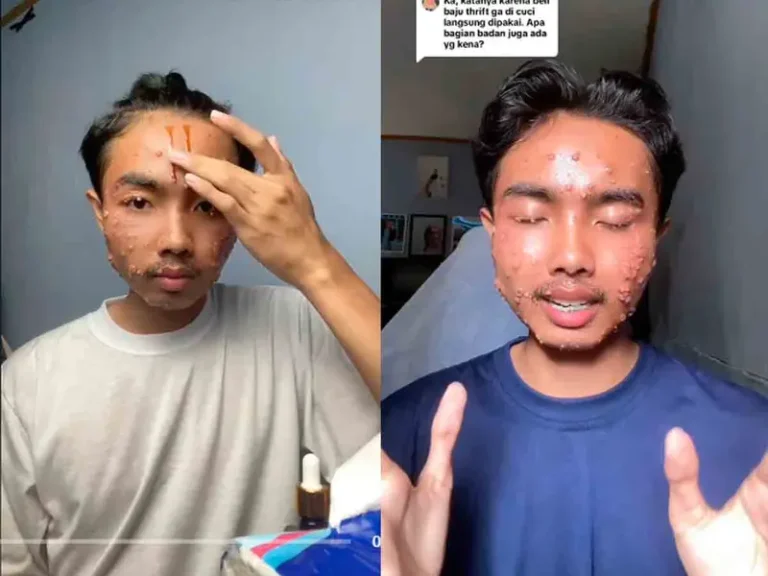 Sufre extraña enfermedad al usar ropa de segunda sin lavarla