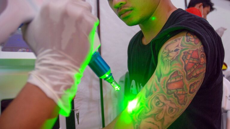 Adiós a los tatuajes feos