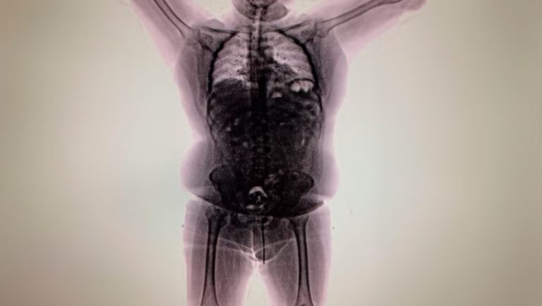 Capturan a sujeto con “una bomba” de cocaína en el estómago