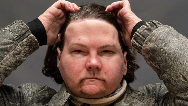 Hombre con trasplante de cara relata lo que vio en su coma de 3 meses