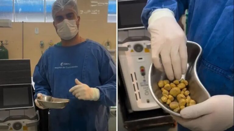 Le extraen 35 piedras del riñón por tomar 2 litros de Coca Cola al día