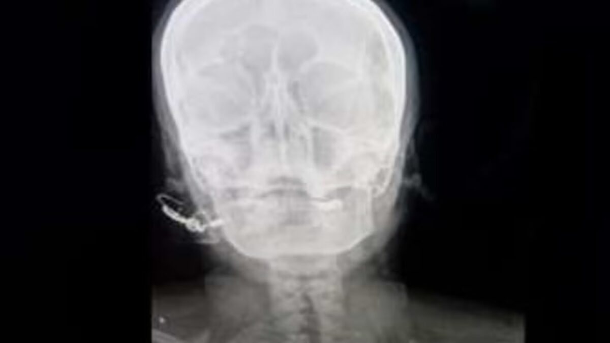 Le incrustan un clavo en la cabeza para que dé a luz a un niño varón