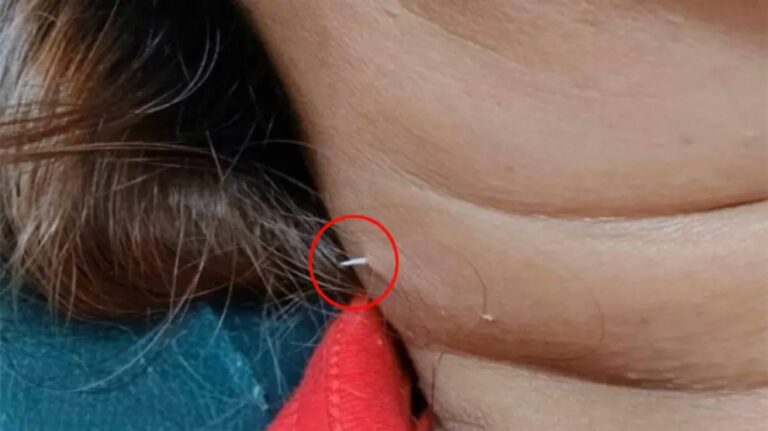 Se traga una espina de pescado y le atraviesa la piel