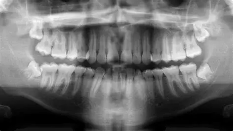 Extraen más de 500 dientes a un niño