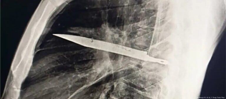 Hombre vivió 8 años con un cuchillo en su pecho