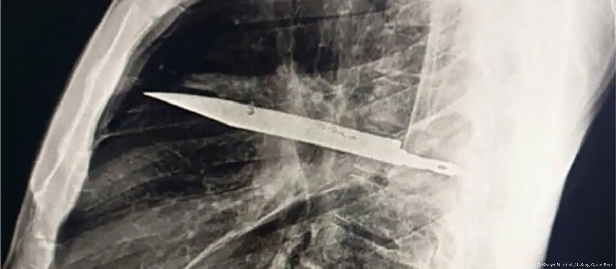 Hombre vivió 8 años con un cuchillo en su pecho