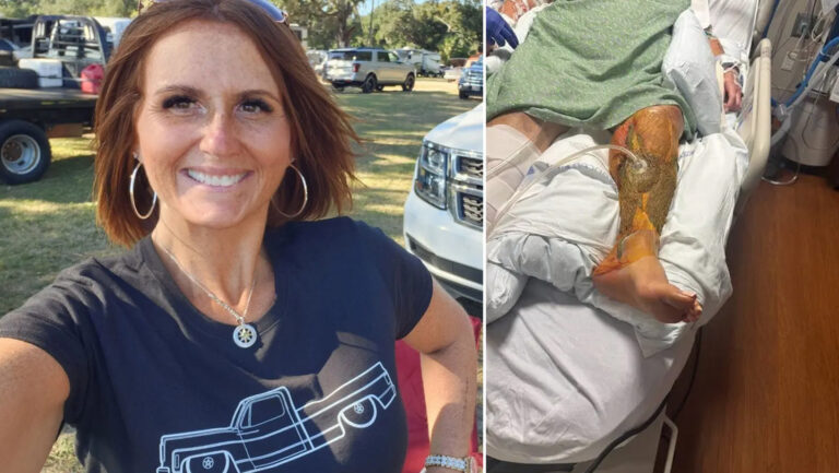Mujer contrae bacteria carnívora en una playa de Florida