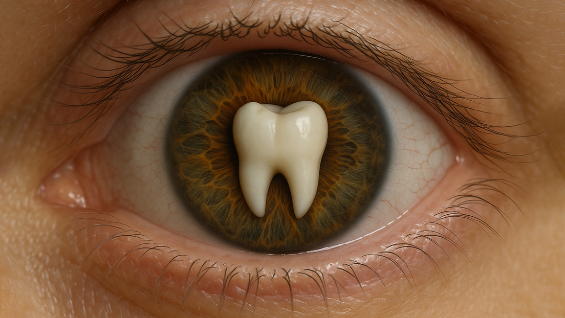 Recupera la vista al implarle un diente en su ojo