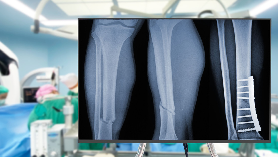 Desarrollan pegamento para unir y fijar huesos