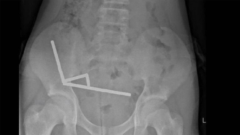 Se traga 100 imanes y le extirpan parte del intestino