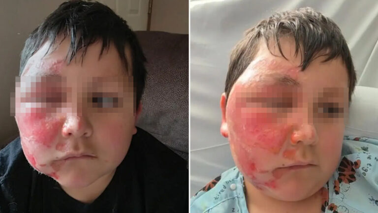 Reto viral en Tik Tok deja a un niño con quemaduras graves en su rostro