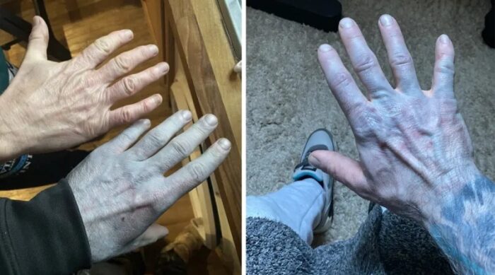 Se duerme bien y se despierta con la piel azul