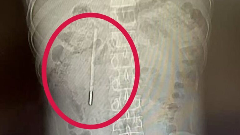 Encuentran un termómetro en el intestino de un hombre