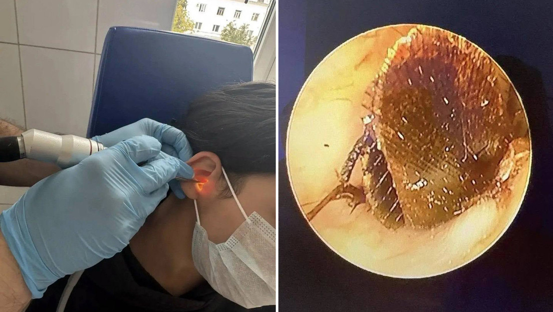 Acude a urgencias por un dolor en el oído y le encuentran una cucaracha