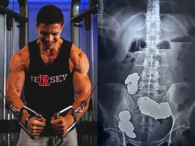 Fisicoculturista se come 39 monedas y termina en urgencias