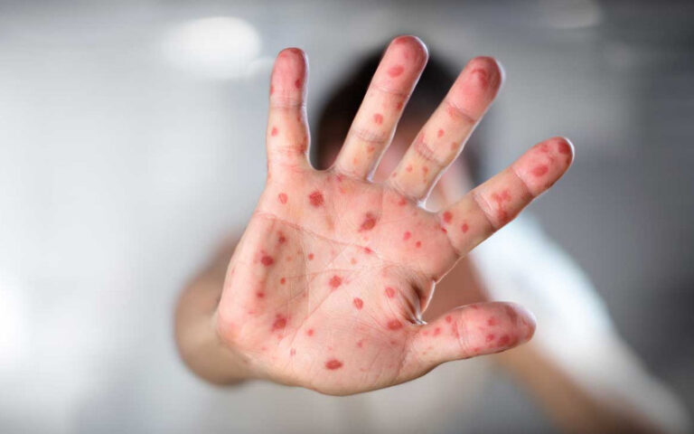 Rusia desarrolla un test que permite detectar el sarampión antes de aparecer sus síntomas