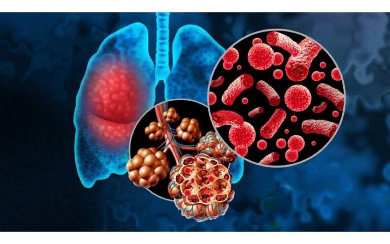 Reportan menos contagios en Leptospirosis y en Neumonía