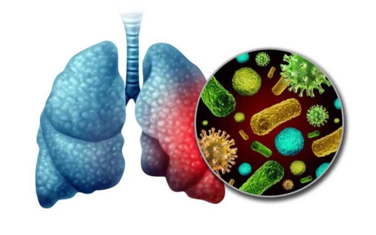 Menos contagios de neumonía y dengue en la última semana en Nicaragua