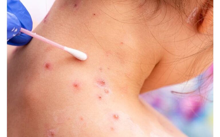 Minsa garantizará la vigilancia epidemiológica ante emergencia de la viruela símica