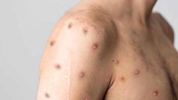 Confirman primera muerte por viruela del mono en Brasil