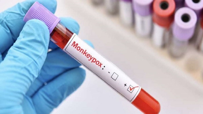 Gobierno peruano reporta 42 casos de viruela símica en un día