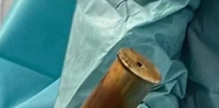 Extraen del ano de un anciano una bomba de la I Guerra Mundial
