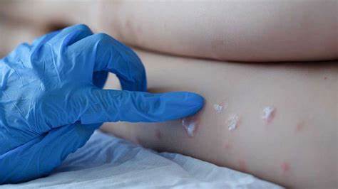 Perú reporta 95 casos confirmados de viruela del mono