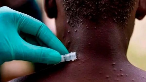 Aumentan a 14 mil los casos de viruela del mono en el mundo