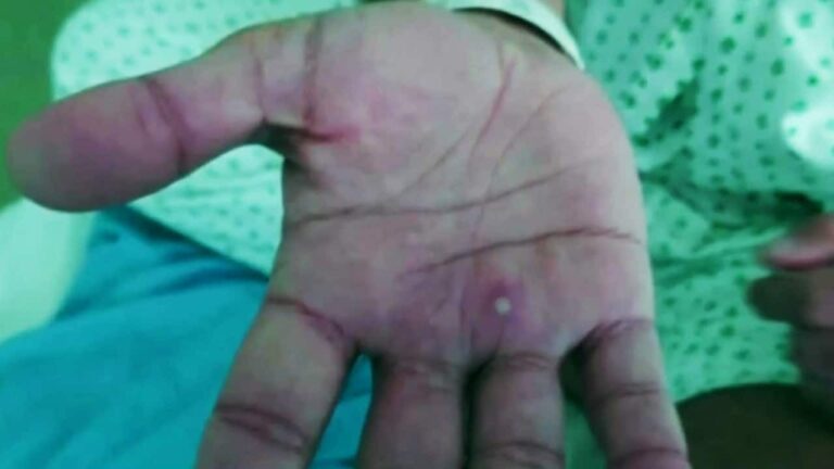 La OMS registra 35 mil casos de viruela del mono y 12 fallecidos