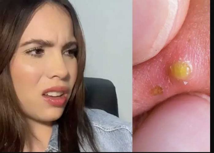 Descubre infidelidad de su novio por una espinilla