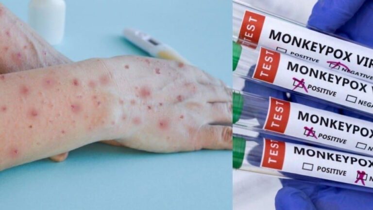 Paraguay reporta su primer caso de viruela del mono