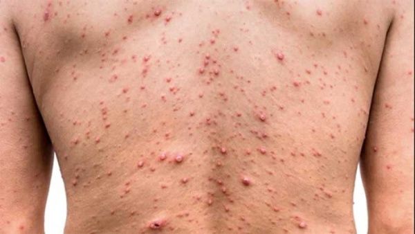 Se registran 6 nuevos casos de viruela en Guatemala