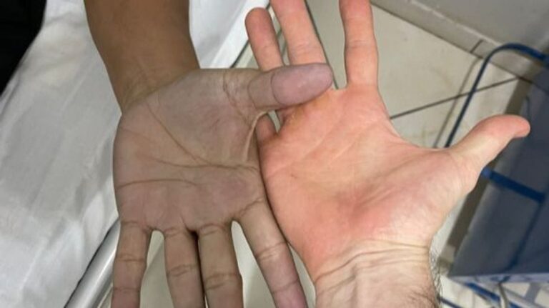 Acude a urgencia por tener las manos azules