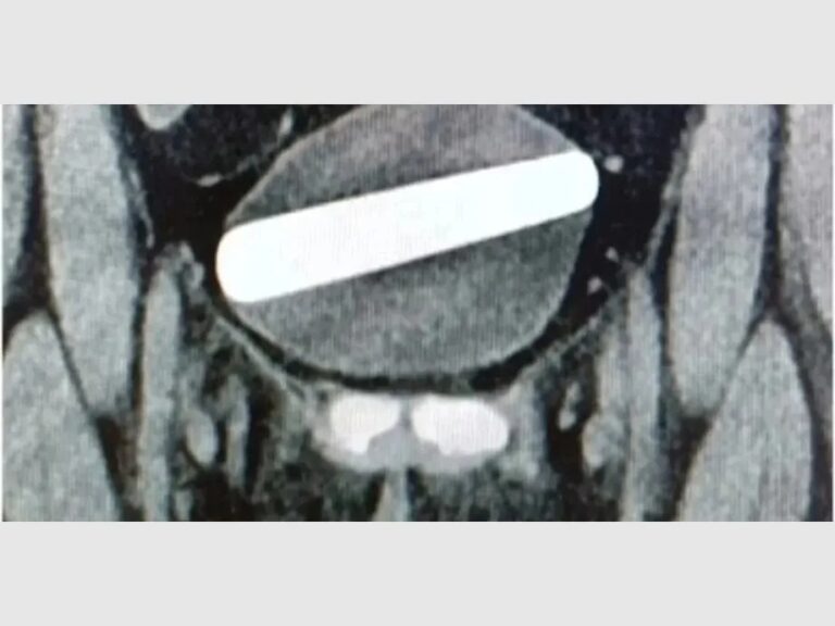 Buscaba placer con un vibrador y termina en el hospital