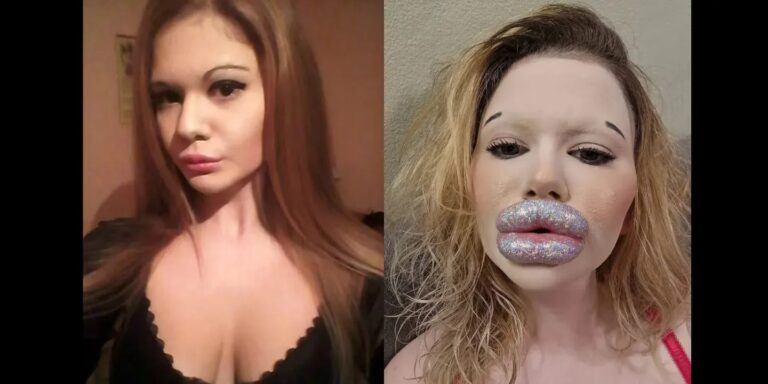 Tiene los labios más grandes del mundo y quiere que continúen creciendo