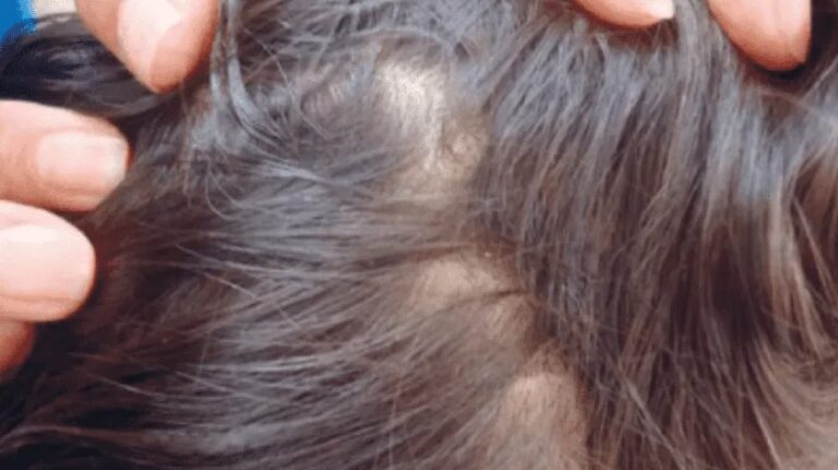 Crea una empresa para sacar piojos y gana miles de dólares