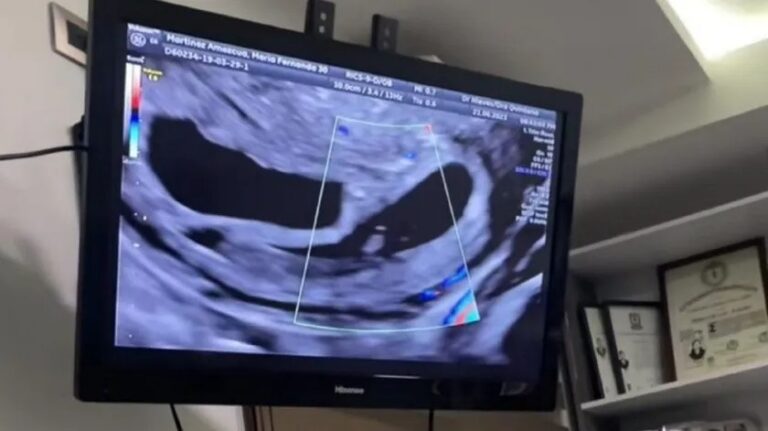 Acude al ginecólogo por unos quistes y le informan que tiene embarazo múltiple