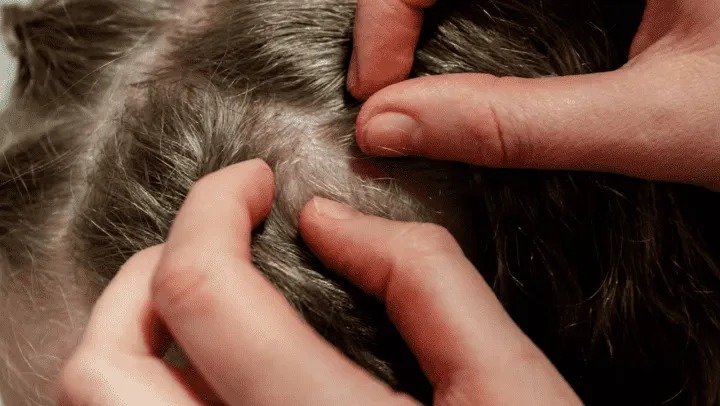 Madre se niega a matar los piojos de su hija