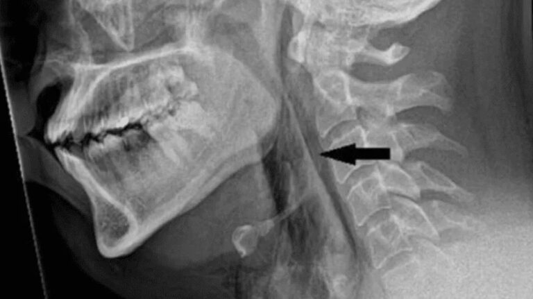 Se contiene un estornudo y sufre desgarro en la traquea