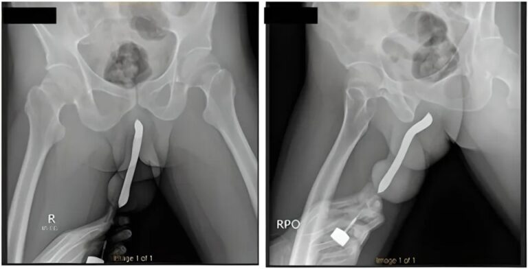 Se introduce un cepillo de dientes en el pene y luego se le quiebra