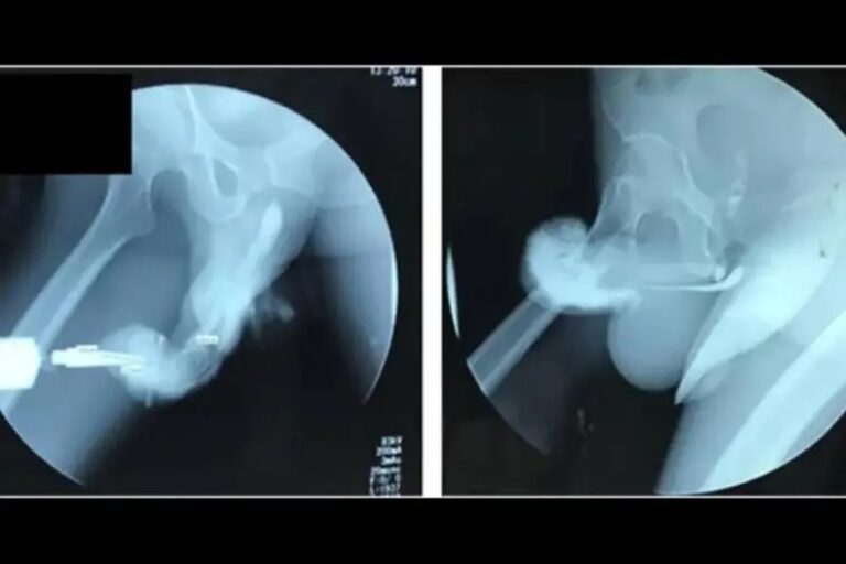 Se fractura el pene durante un encuentro íntimo “salvaje”