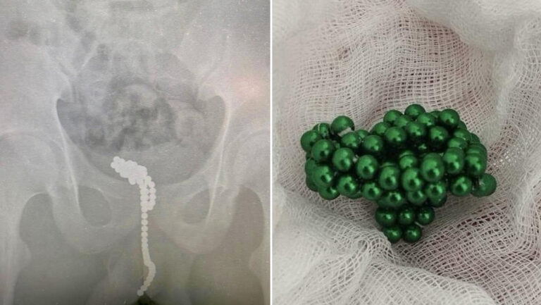 Adolescente se coloca 60 bolas magnéticas en su órgano reproductor