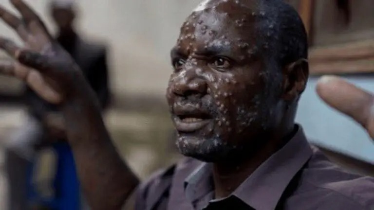 Más de 500 personas han fallecido por viruela del mono