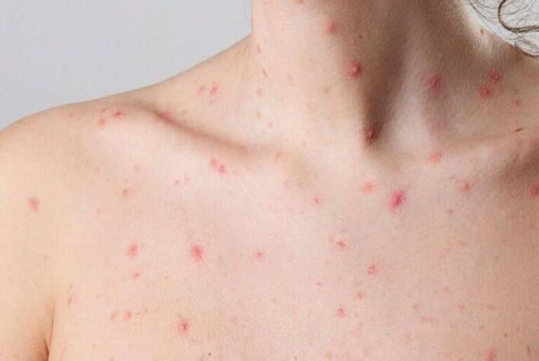 Venezuela tomará acciones ante la propagación de la Viruela del Mono